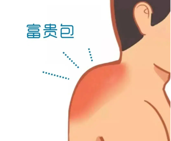 如何消除富贵包