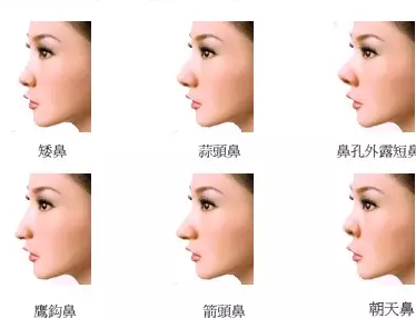 朝天鼻是什么样的？朝天鼻的人命运好吗？