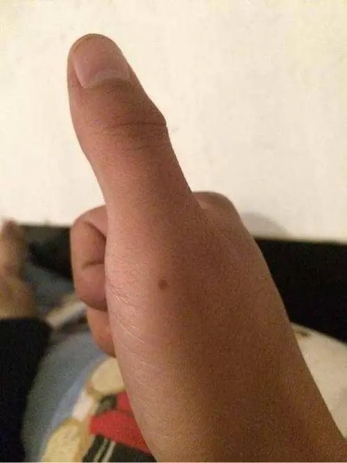 大拇指有痣代表什么意思