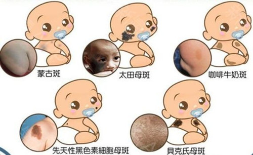 胎记的位置与命运怎么看