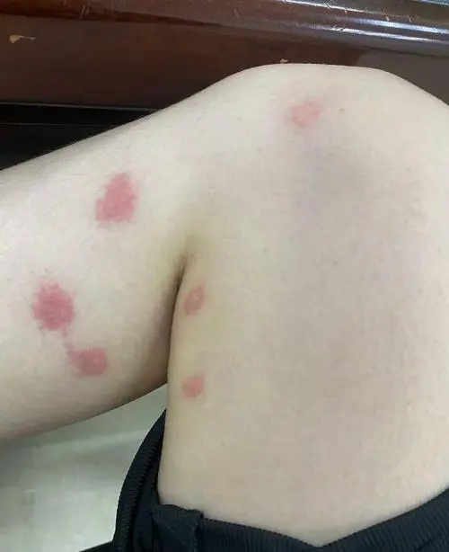 跳蚤咬的有什么明显特征
