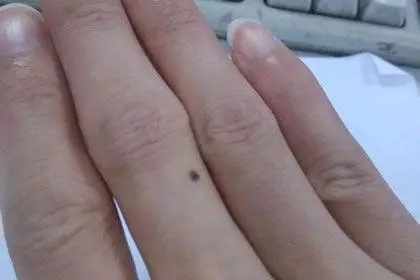 手指长痣是什么预兆