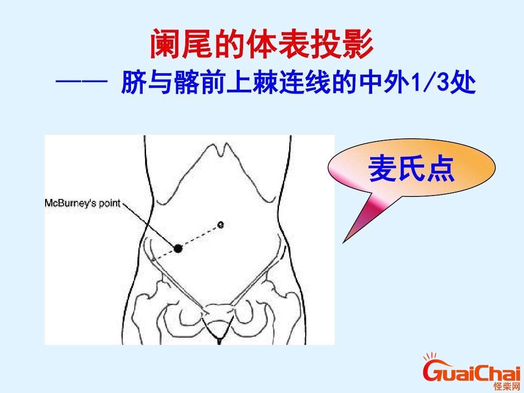 阑尾炎在哪个位置图片大全 阑尾炎在哪个位置