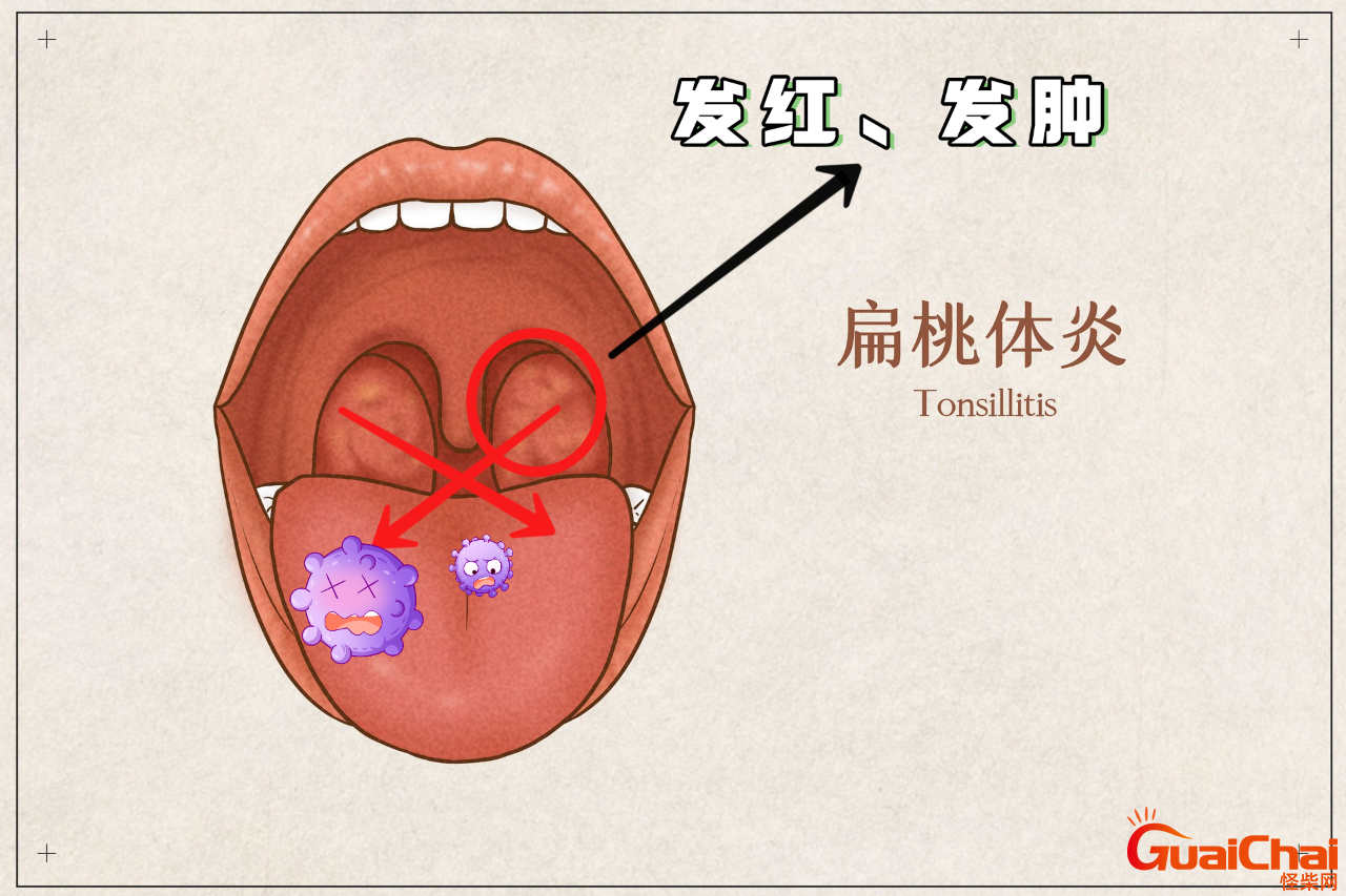 扁桃体发炎的症状有哪些症状？扁桃体发炎吃什么药效果好