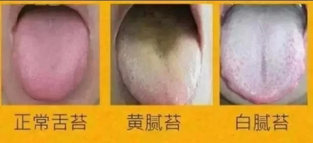 舌苔黄腻是什么原因引起的怎么解决？舌苔黄腻是什么原因吃什么药