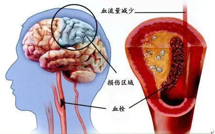 脑梗塞的原因是？脑梗塞是怎么引起的？