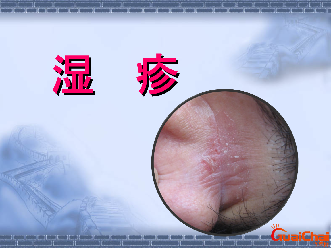 湿疹怎么治好得快用什么药？湿疹怎么治疗能去根