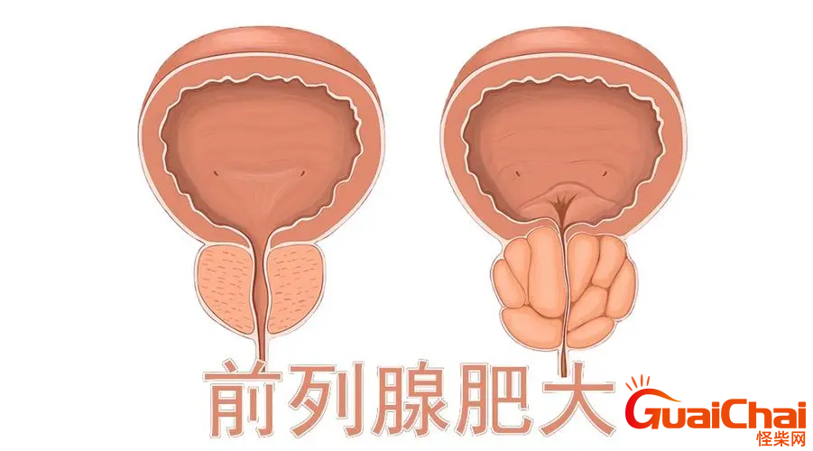 【前列腺增生肥大】前列腺增生肥大什么原因？前列腺增生肥大怎么造成的？