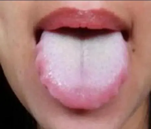 【舌苔厚白】舌苔厚白的原因？为什么会舌苔厚白？