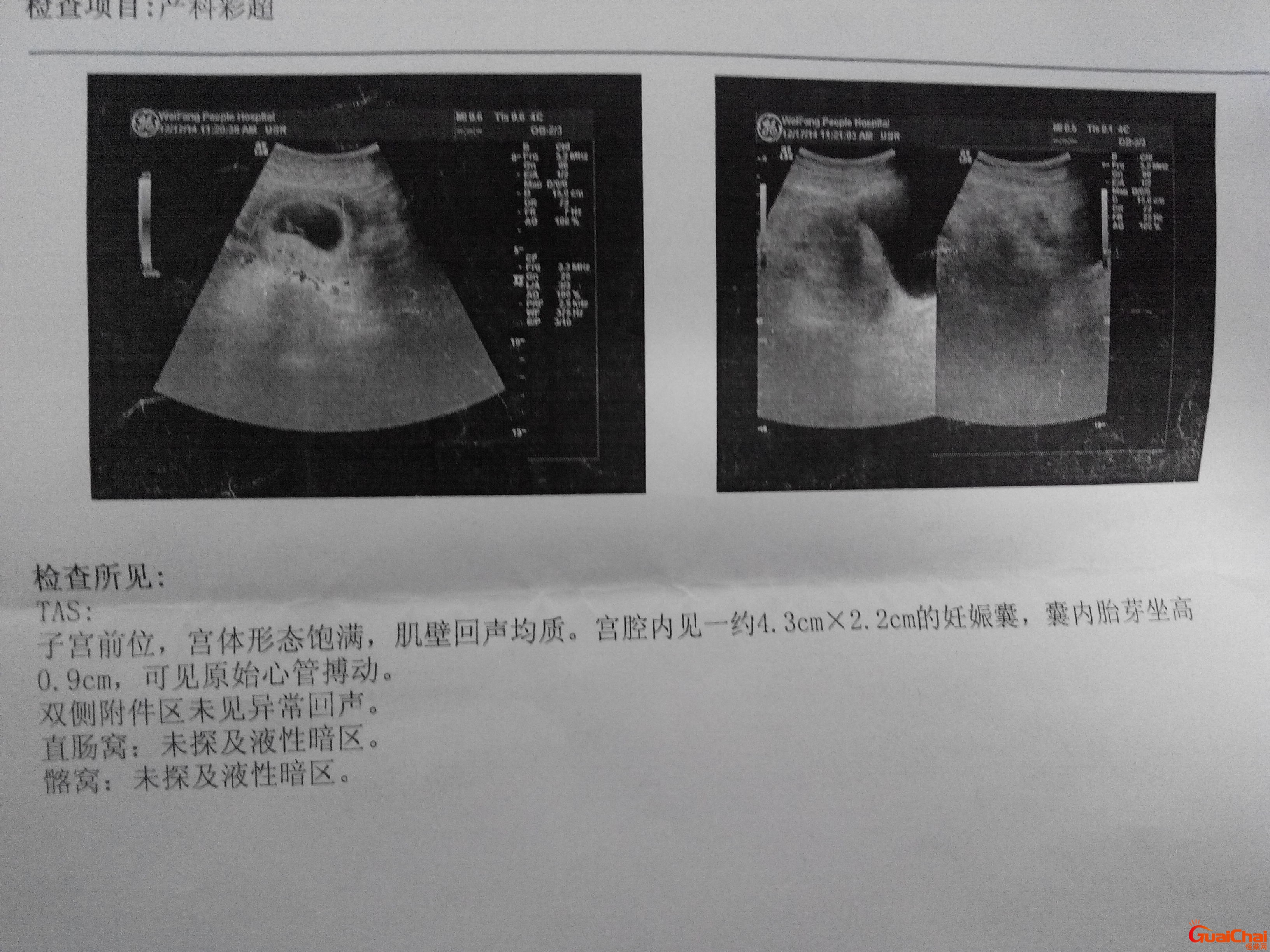 孕囊拍出来是什么样？孕囊形状看男女超准