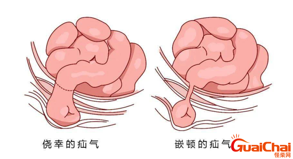 疝气最简单的消除方法是什么？疝气怎么治？