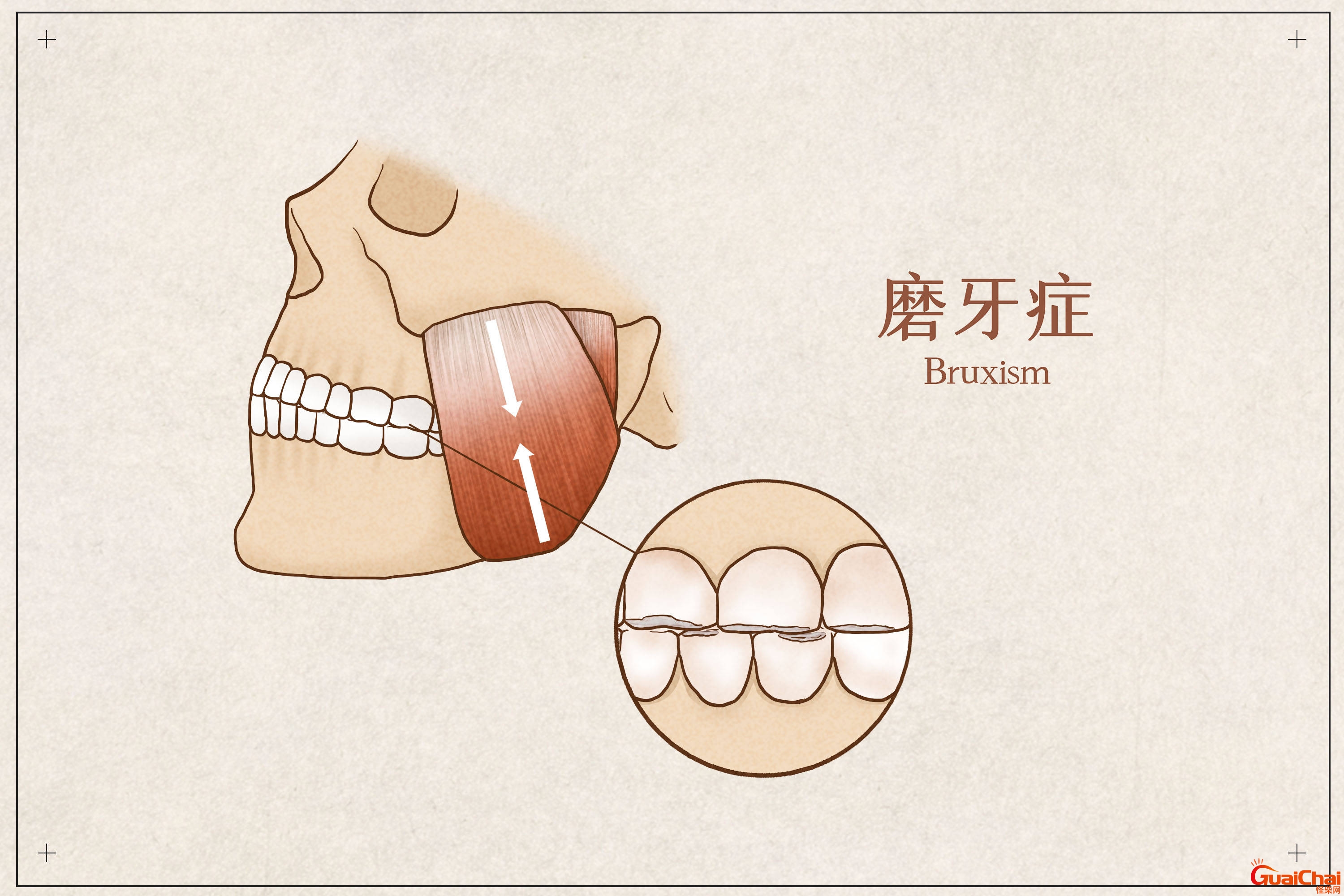 磨牙是什么原因引起的？磨牙怎么办才能治好