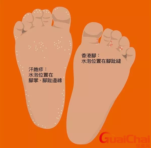 香港脚怎么治才能除根？香港脚是什么意思