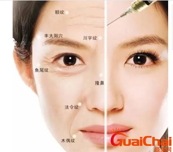川字纹是打玻尿酸还是除皱针好？川字纹是打玻尿酸还是除皱针多少钱