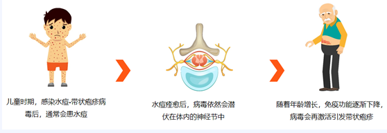 带状疱疹缠上身？揭秘蛇缠腰的发病原因与治疗方法！